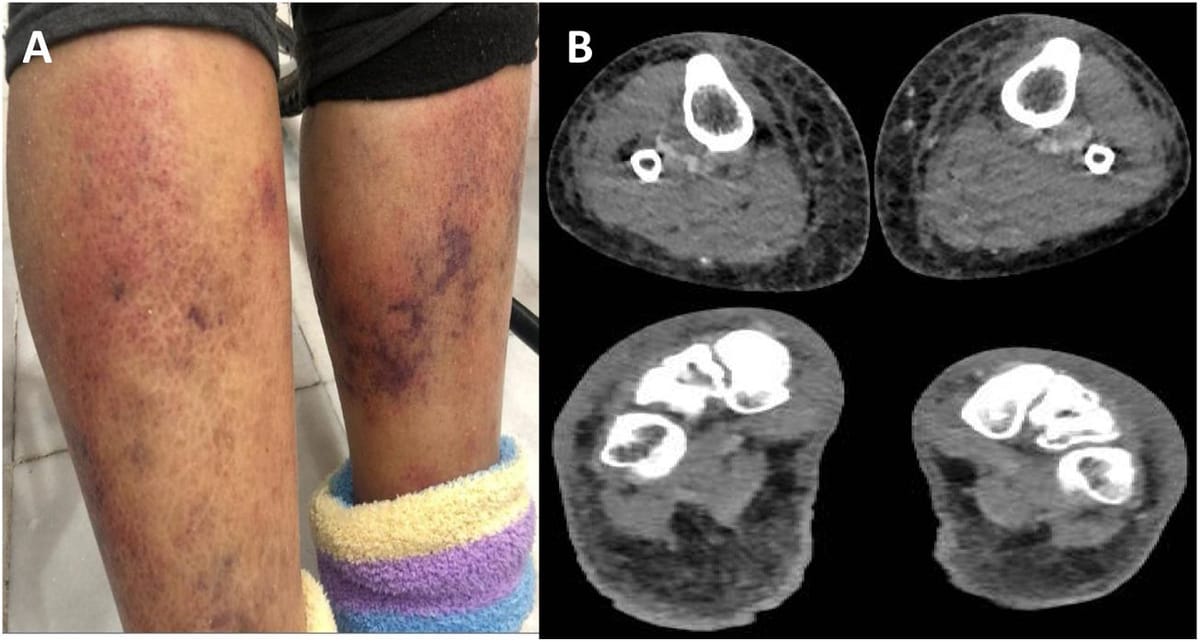 Alerta en EE. UU. por aumento de casos de la “bacteria carnívora” Vibrio vulnificus Post feature image