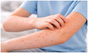 Aumentan a siete los casos confirmados de sarampión en Hidalgo Post feature image