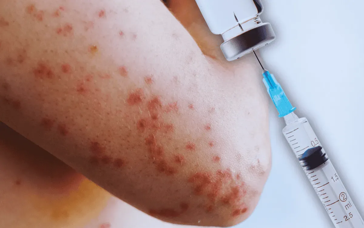 Progreso de Obregón, toma medidas de prevención en contra del sarampión Post feature image