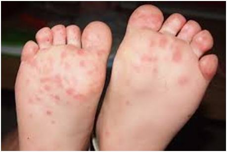 Hidalgo registra tres brotes activos de coxsackie; uno de ellos es comunitario Post feature image