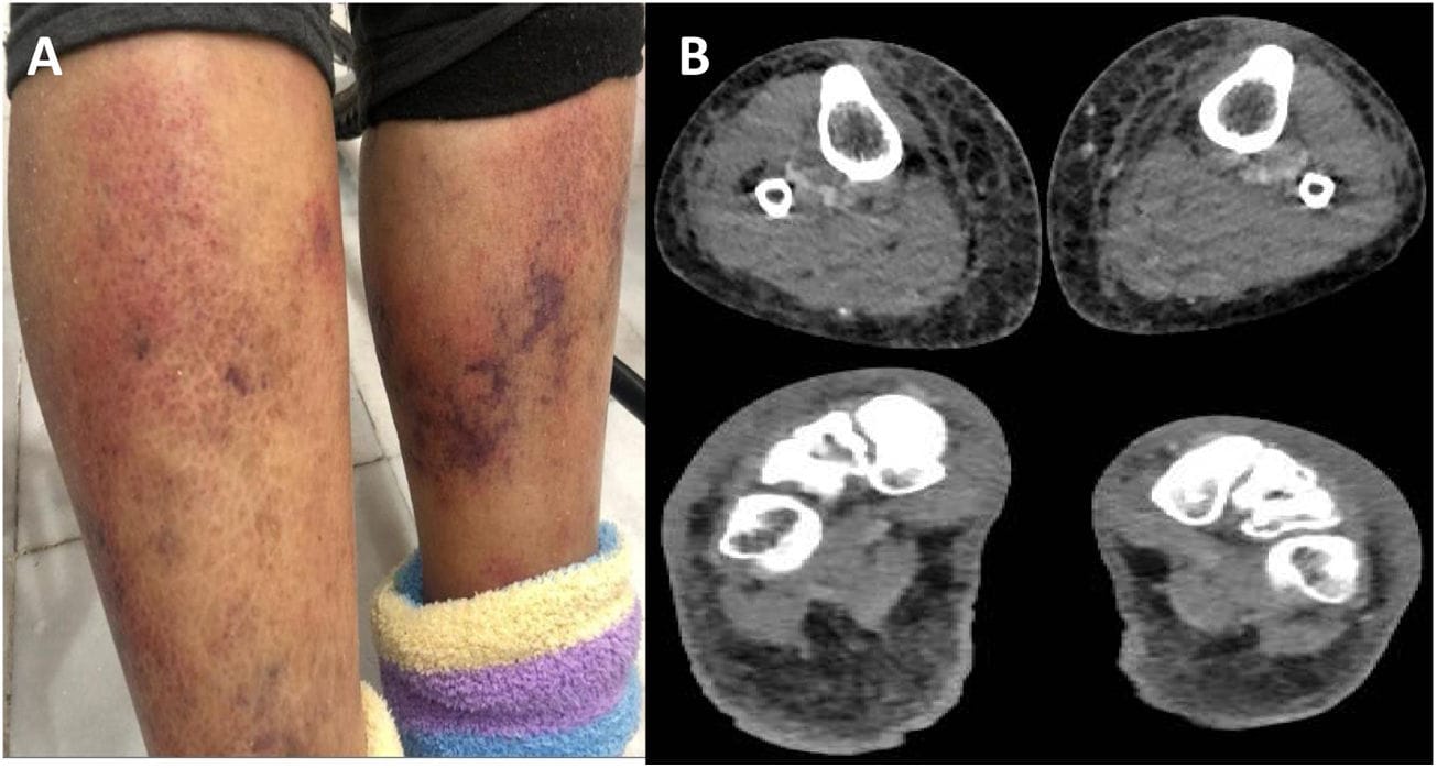 Alerta en EE. UU. por aumento de casos de la “bacteria carnívora” Vibrio vulnificus imagen destacada