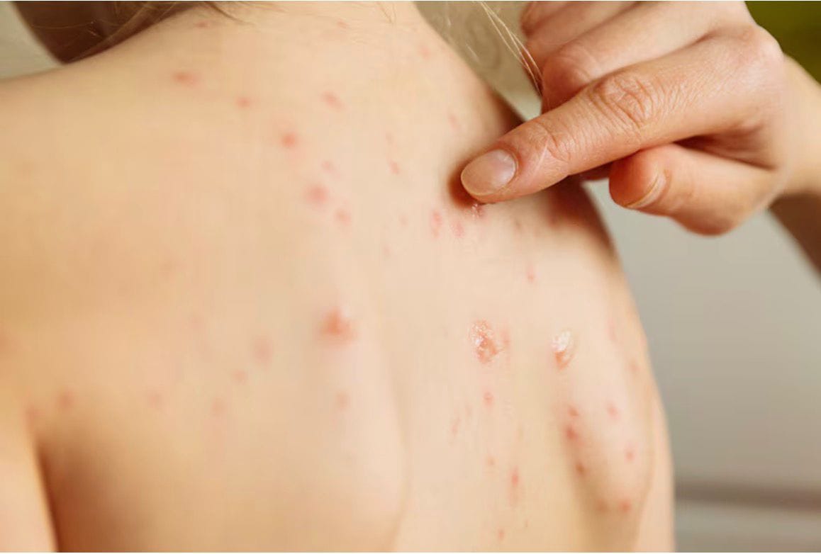 Confirman el primer caso de Sarampión en Hidalgo imagen destacada