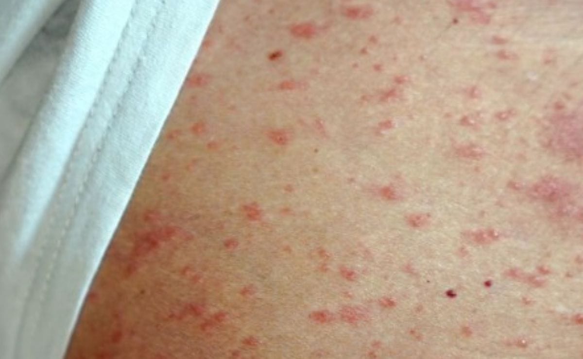 Autoridad estatal confirma 5 casos de sarampión en Hidalgo imagen destacada