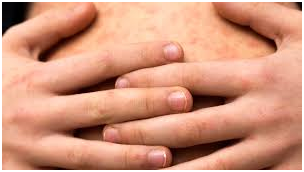 Autoridades sanitarias confirman nuevos casos de sarampión en Actopan imagen destacada